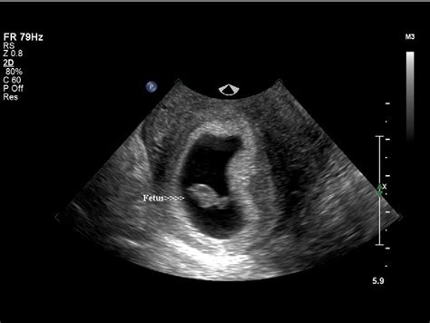 Placenta Positions On Ultrasound