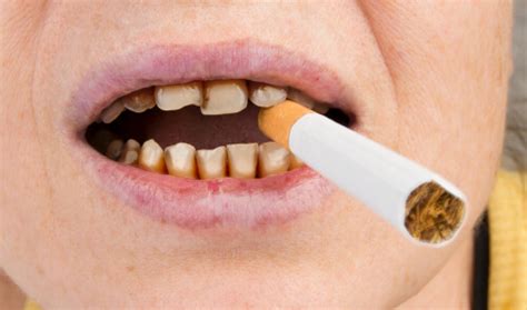 Does tobacco stain teeth? Nicotine and tar are to blame