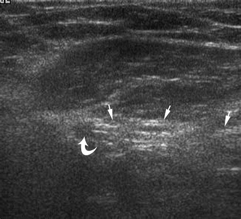 Direct Inguinal Hernia Ultrasound