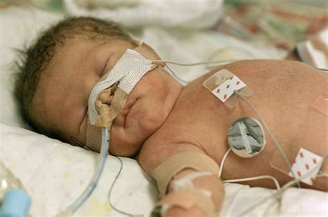 Hypoxic-Ischemic Encephalopathy in the Neonate - Scope Heal