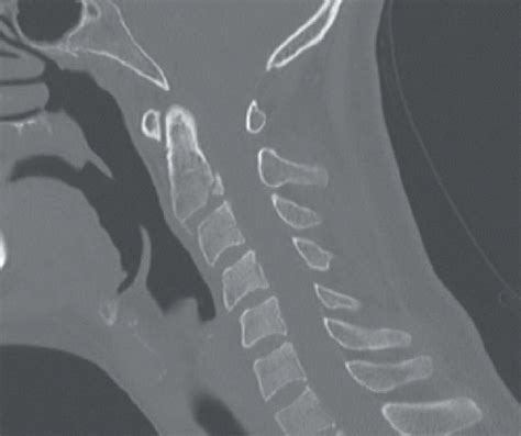 Hangman Fracture | Radiology Key