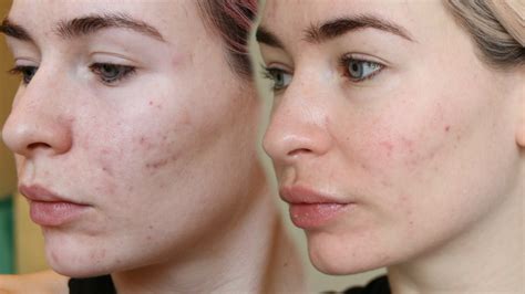 ROACCUTANE MONTH 3 - Side Effects + My Skin Now - Katie Snooks