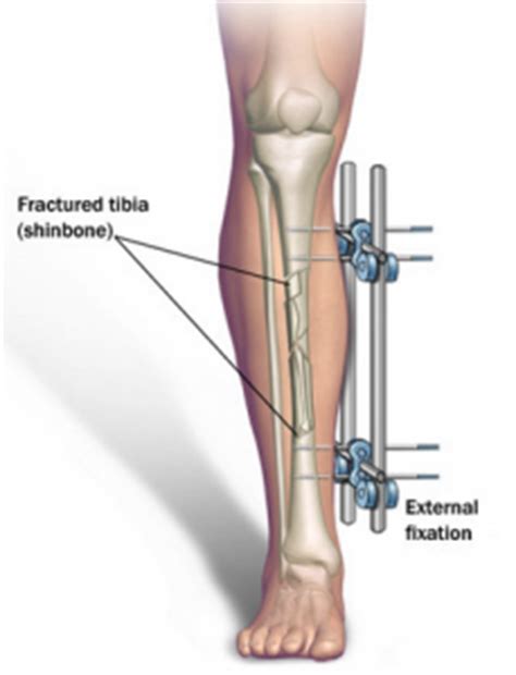 A Complete Guide To Limb Lengthening Surgery