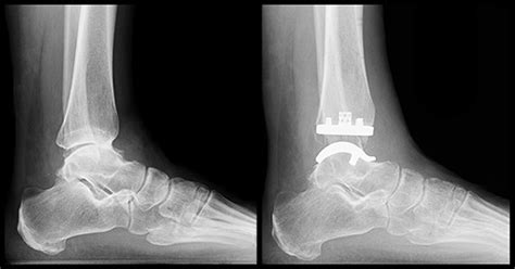 Ankle Replacement Surgery: How It Works, Recovery Time | HSS