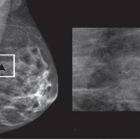 A. Normal synthetic craniocaudal mammogram of right breast. B ...