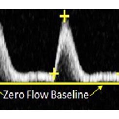 Spectral Doppler waveforms demonstrate laminar (A), disturbed (B), and... | Download Scientific ...