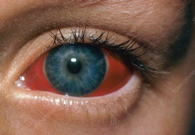 Subconjunctival Hemorrhage - Stock Image - C014/4409 - Science Photo ...