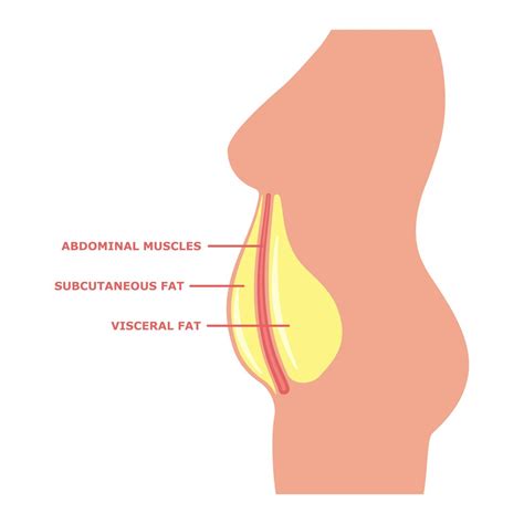 Visceral Fat Vs. Subcutaneous Fat: Will Lipo Help Either?