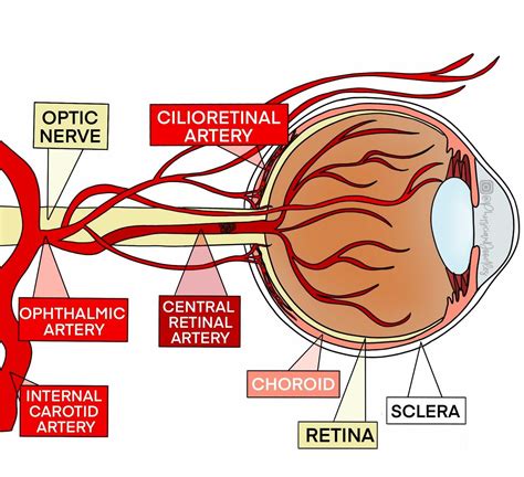 CRAO • The Eye Stroke – CriticalCareNow