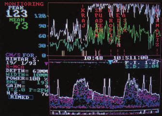 TCD shows initial vasospasm in the MCA at the end of the ruptured ...