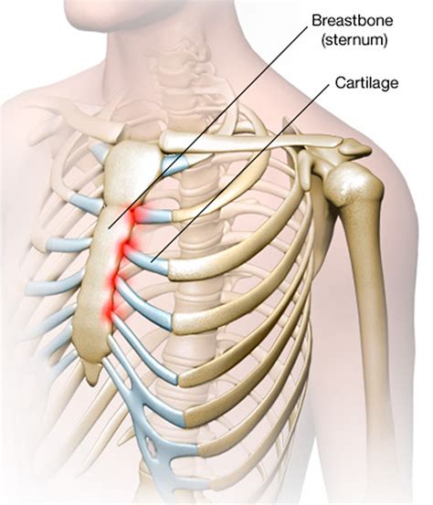 Costochondritis - Causes, Symptoms, Locations, Duration & Treatment