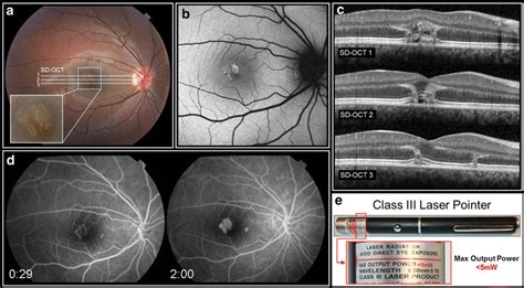 Funduscopic findings at presentation as documented via multimodal... | Download Scientific Diagram