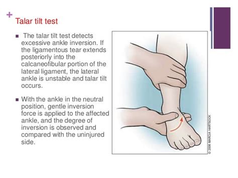 Ankle sprain