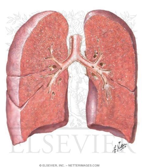 Miliary Tuberculosis