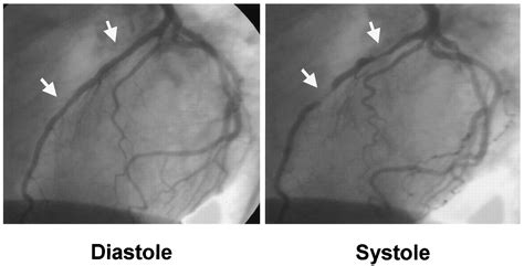 Update on Myocardial Bridging | Circulation