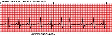 Premature Junctional Contractions