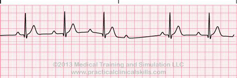 Heart Block Rhythms ECG Course: Bundle Branch Block