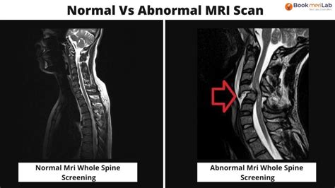 MRI Whole Spine Screening: Purpose, Results & Cost [2024]