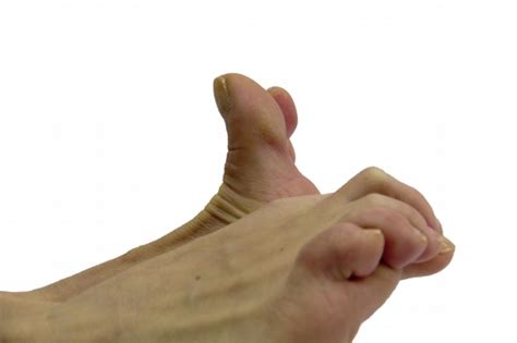 Initial exercises – Treatment of Hallux valgus and Haluks – CompleVita