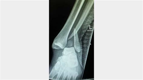 Dislocated Ankle: Symptoms, Causes & Treatment Explained