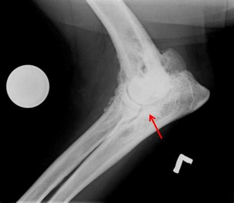 Elbow: fragmented medial coronoid process 05 - radiograph mediolateral ...