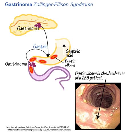 Clinical Pathology Glossary: Gastrinoma & Zollinger-Ellison Syndrome | ditki medical ...