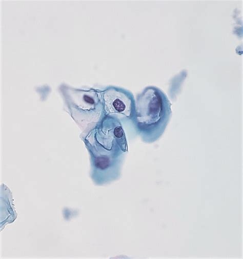 [Figure, Koilocytes on a Papanicolaou stain of cervical cells ...