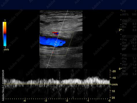 Ultrasound doppler of femoral vien for finding deep vein thrombosis or ...