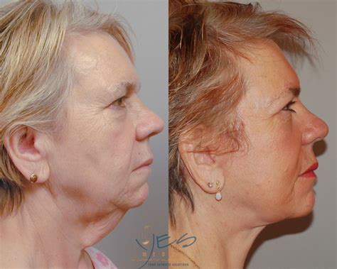 Face Lift & Neck Lift Before & After Photos Patient 91 | Vancouver, BC ...