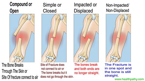 Different Types Of Fractures A Simple Classification Of Fractures ...