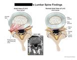 AMICUS Illustration of amicus,injury,lumbar,spine,annular,tear,protrusiton,right,foraminal,zone ...