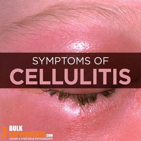 Cellulitis: Symptoms, Causes & Treatment