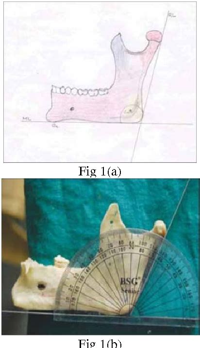 Figure 1 from Determination of Angle of Mandible from Mandibular Bones and Orthopantomograph ...