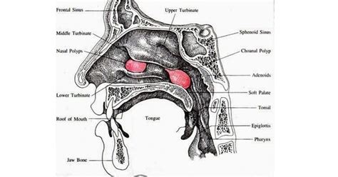 Ethmoidal Polyp - www.medicoapps.org