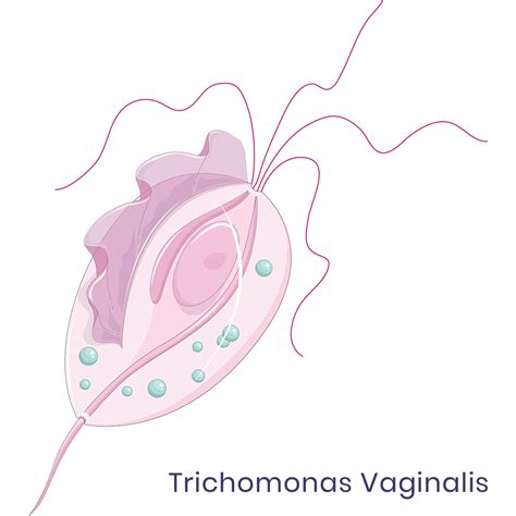 Trichomonas vaginalis infection - symptoms, causes, treatment ...