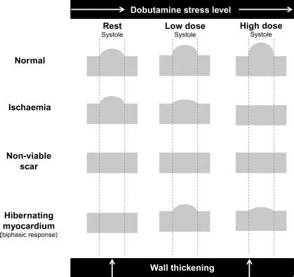 Global Lv Hypokinesia With Regional Variation - QLABOL