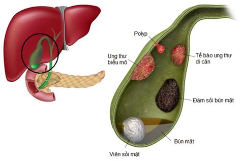 Treatment of gallbladder polyps by laparoscopic cholecystectomy | Vinmec