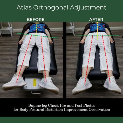 Atlas Orthogonal Adjustment: Before & After | Chronic pain awareness ...