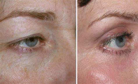 Eyelid Cancers – Treatment & Removal | Facial Plastic Surgeon India