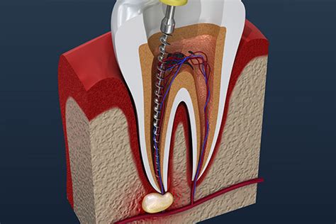 Root Canal Treatment - Dental Matters