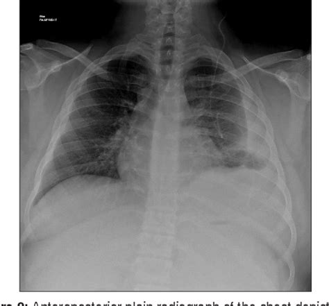 Figure 2 from Nuclear Medicine to Evaluate Complications of Cerebral Shunts: Two Cases and ...