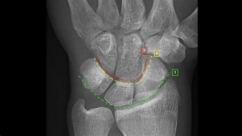 Wrist X-ray Interpretation - OSCE Guide | Geeky Medics