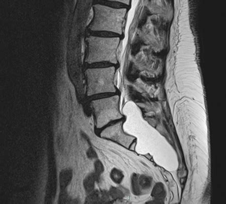 Tarlov Cyst Thoracic Spine