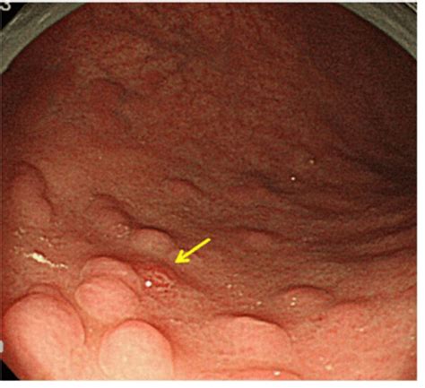 AKCHRISYOUNG: WHAT IS ATROPHIC GASTRITIS