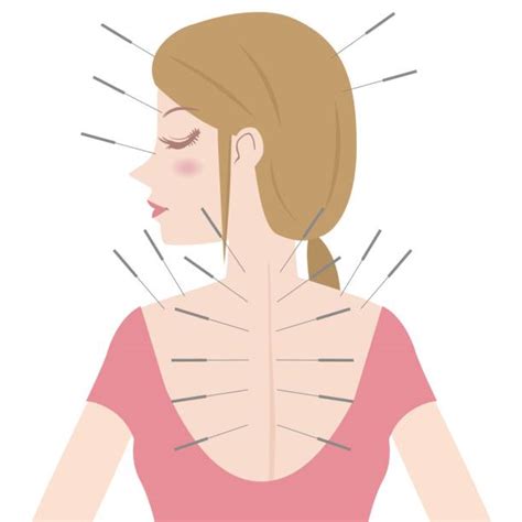 Royalty Free Acupuncture Clip Art, Vector Images & Illustrations - iStock