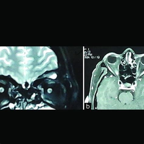 Coronal FLAIR MRI: In left Sylvian fissure, as result of multiple ...