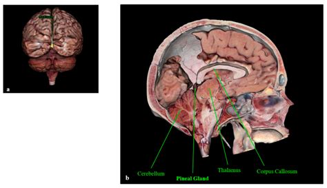 Pineal Gland Disorders