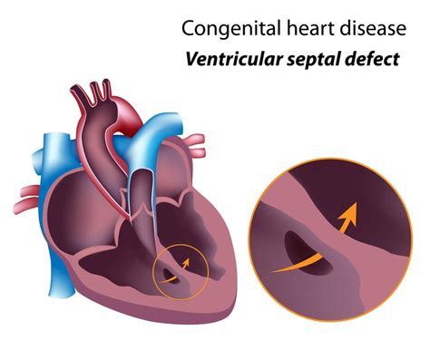 What Is a Heart Murmur? It May Be Harmless—or It May Indicate Heart ...