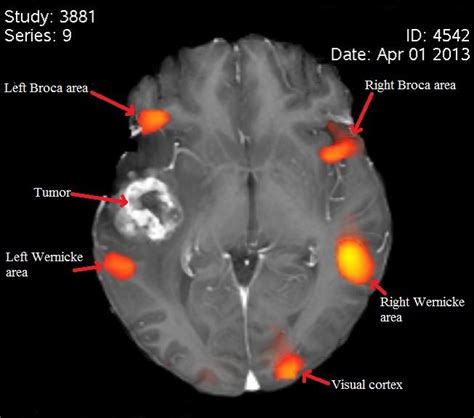 broca's area mri - Поиск в Google