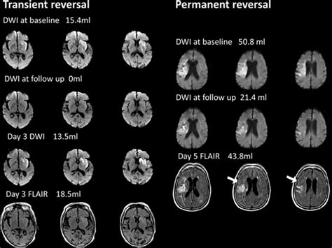 Early Diffusion-Weighted Imaging Reversal After Endovascular Reperfusion Is Typically Transient ...